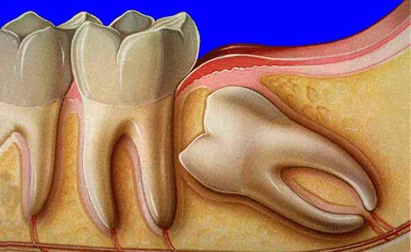 Nhổ răng khôn, còn được gọi là phẫu thuật nhổ răng số 8, là một quá trình phẫu thuật thông thường trong nha khoa